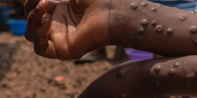 Mpox cases rise to 38 in Nakonde